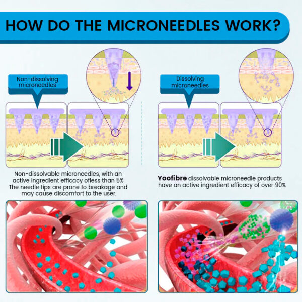 Yoofibre Next-Generation Pain-Free Injection Nano Microneedle Patch